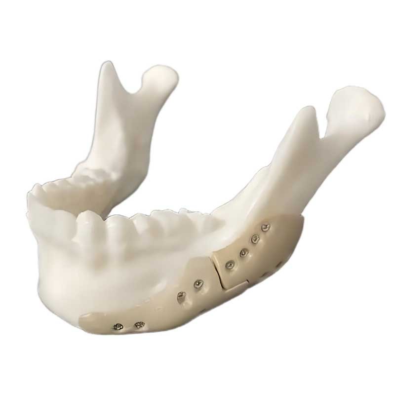 3D Printing of the Mandible